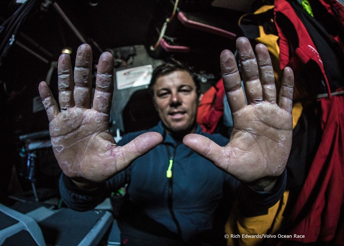Team Scallywag crew member showing his hands to the Onboard Reporter - (c) Rich Edwards/Volvo Ocean Race